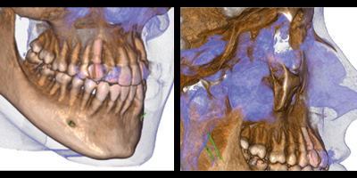 imagen de mandíbula vista a través de CB3D de alta resolución