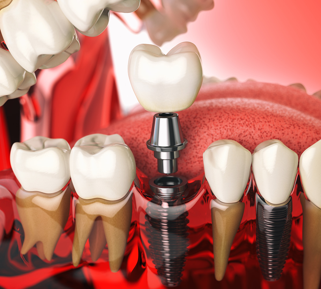 imagen de un implante dental en Clínica Dental Valeria Bolbarán. 