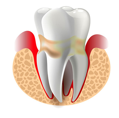 dibujo de muela con problema de Periodontitis