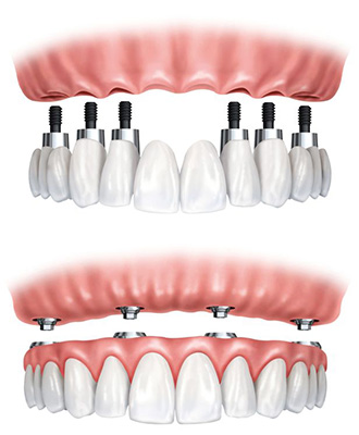 Ilustración para informar de la colocación de prótesis en Clínica Dental Valeria Bolbarán